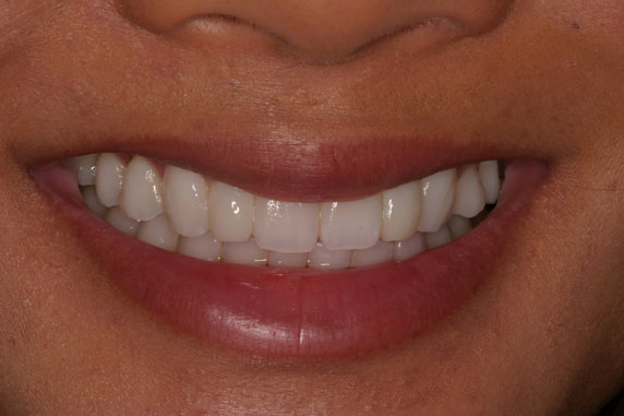 After image of Amanda got BioClear treatment at Nancy Shiba, DDS 