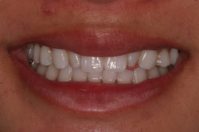 Before image of Amanda gets BioClear treatment at Nancy Shiba, DDS 