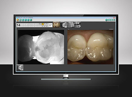 Screen of X-ray and tooth picture that detected dental caries.