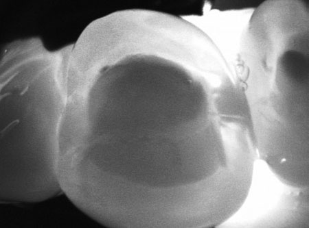 X-ray image of CariVu example