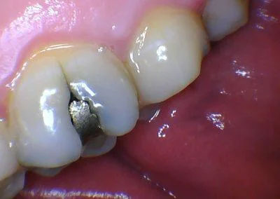 Sample image of using intraoral camera, captured filling tooth.