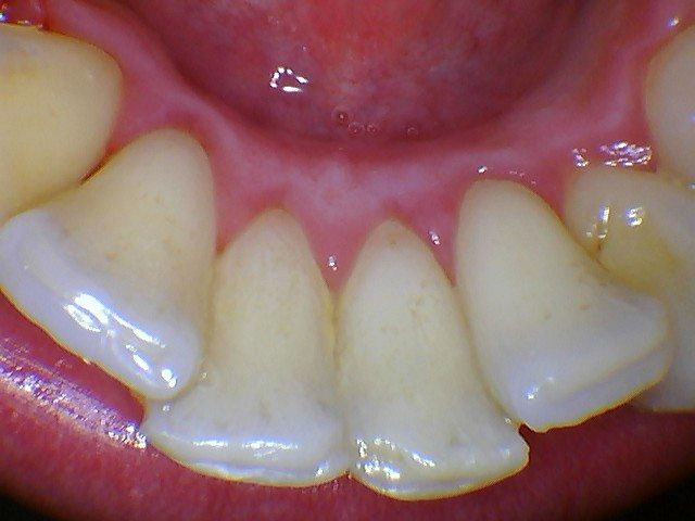 Sample image of using intraoral camera, captured gum line.