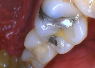 Sample image of using intraoral camera, captured filling tooth.