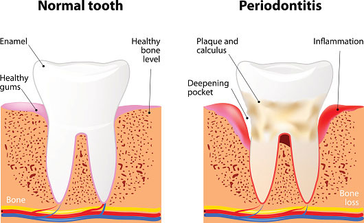 The importance of Periodontal Maintenance is shown through a Periodontal Disease Diagram