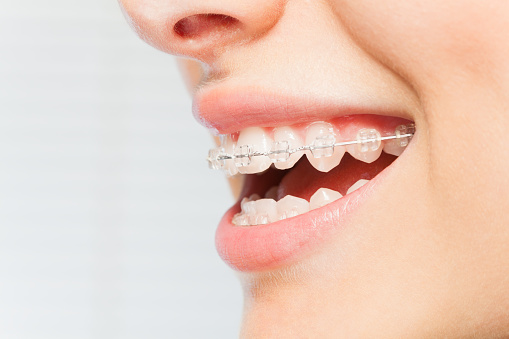 What Do the Rubber Bands Help Do When Used on Traditional Braces?