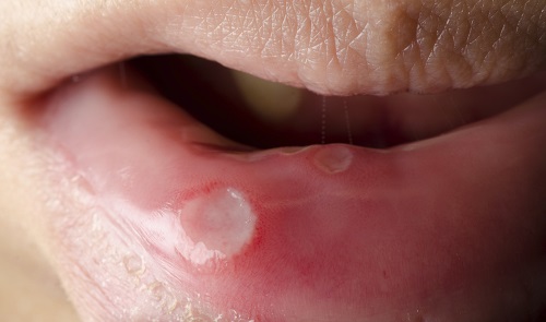 Close-up of mouth with a sore at Nancy Shiba, DDS