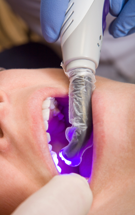 Why Don't Dentists Use Alternatives to Amalgam?
