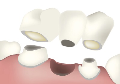 What are the Different Types of Dental Bridges?