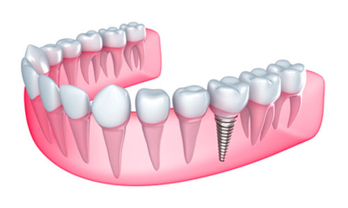 Benefits of Full-Arch Dental Implants