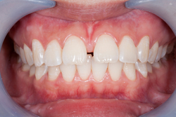 Close-up of healthy teeth and gums at Nancy Shiba, DDS