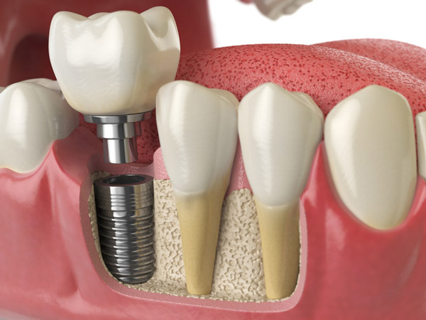 Diagram of a dental implant in the jaw bone.