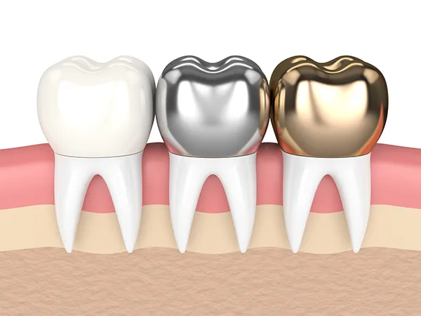 3D rendered cross-section view of three teeth with dental crowns made of different materials at Nancy Shiba, DDS in San Jose, CA