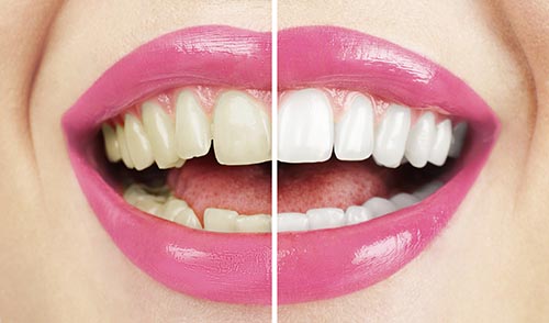 Fight dental stains with these tips by Nancy Shiba, DDS in CA