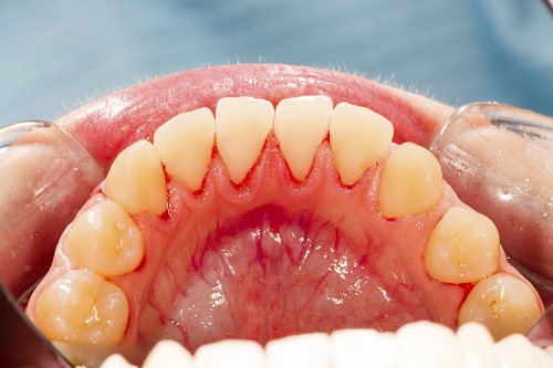 A patients mouth suffering from gum disease.