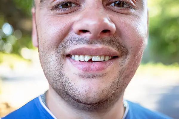 Smiling man outdoors showing a front tooth with a large chip, emphasizing the need for dental care.