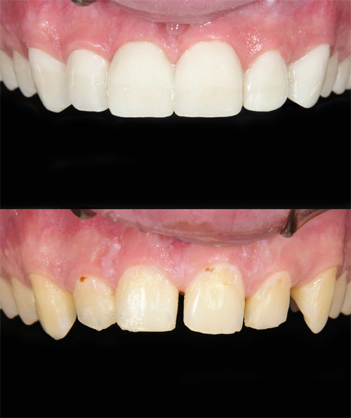 Before and after dental veneers placed at Nancy Shiba, DDS in San Jose, CA
